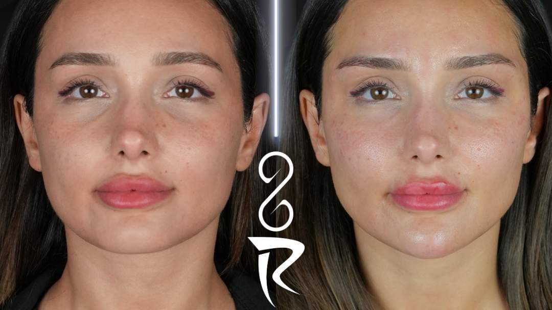 Dudak, çene ve jawline dolgu uygulamaları