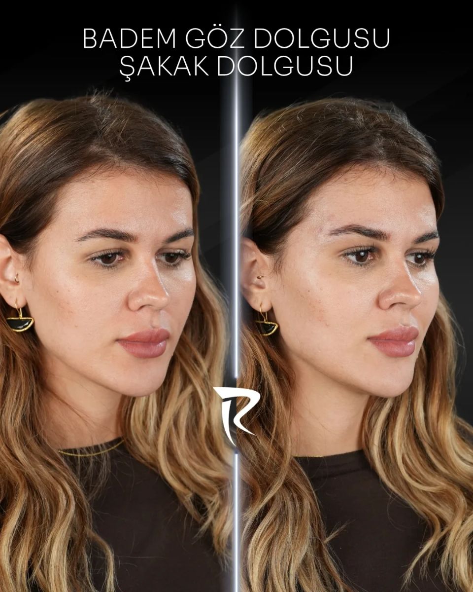 Badem göz ve şakak dolgusu — yandan çekim, öncesi ve sonrası