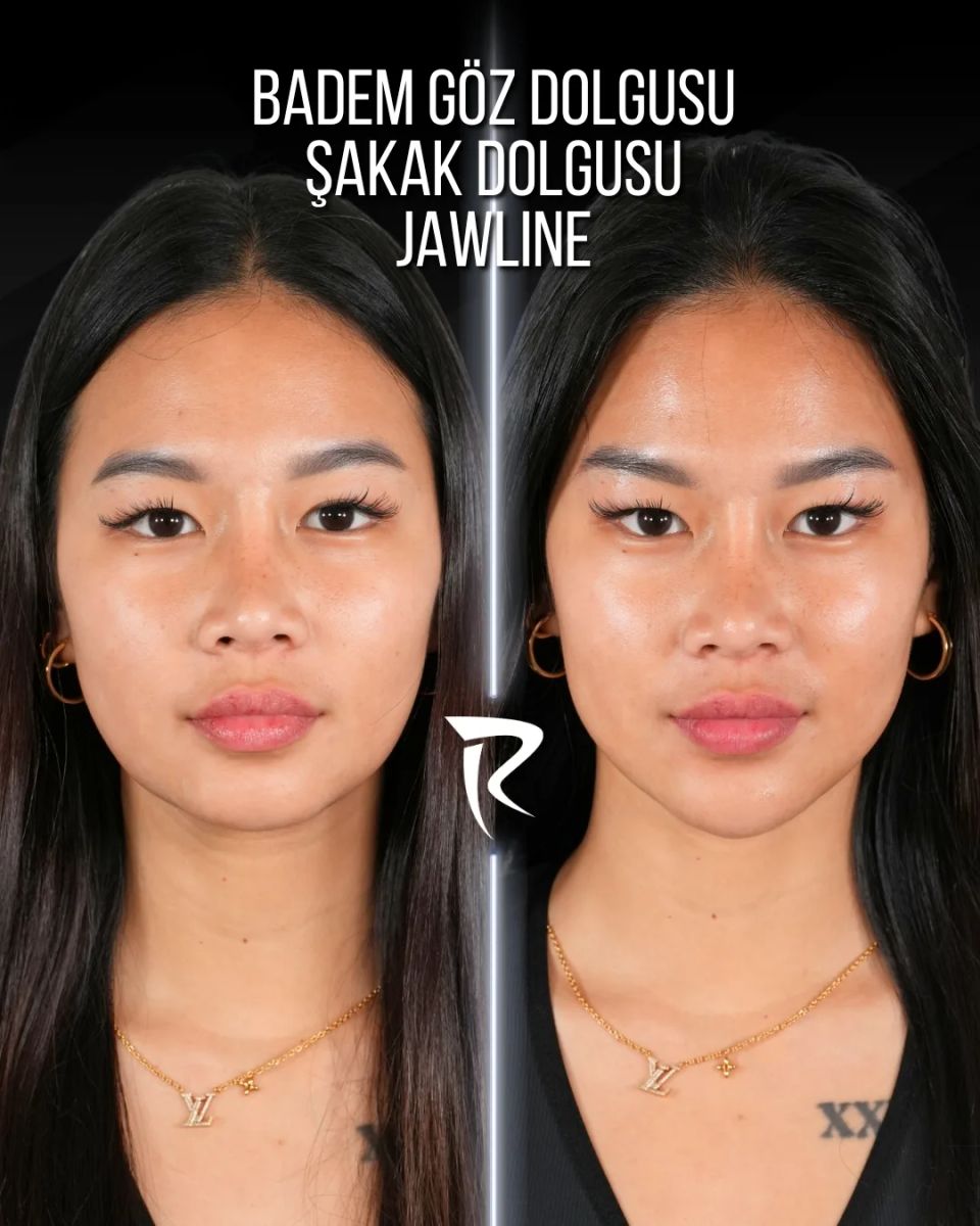Badem göz, şakak ve jawline dolgusu — önden çekim, öncesi ve sonrası