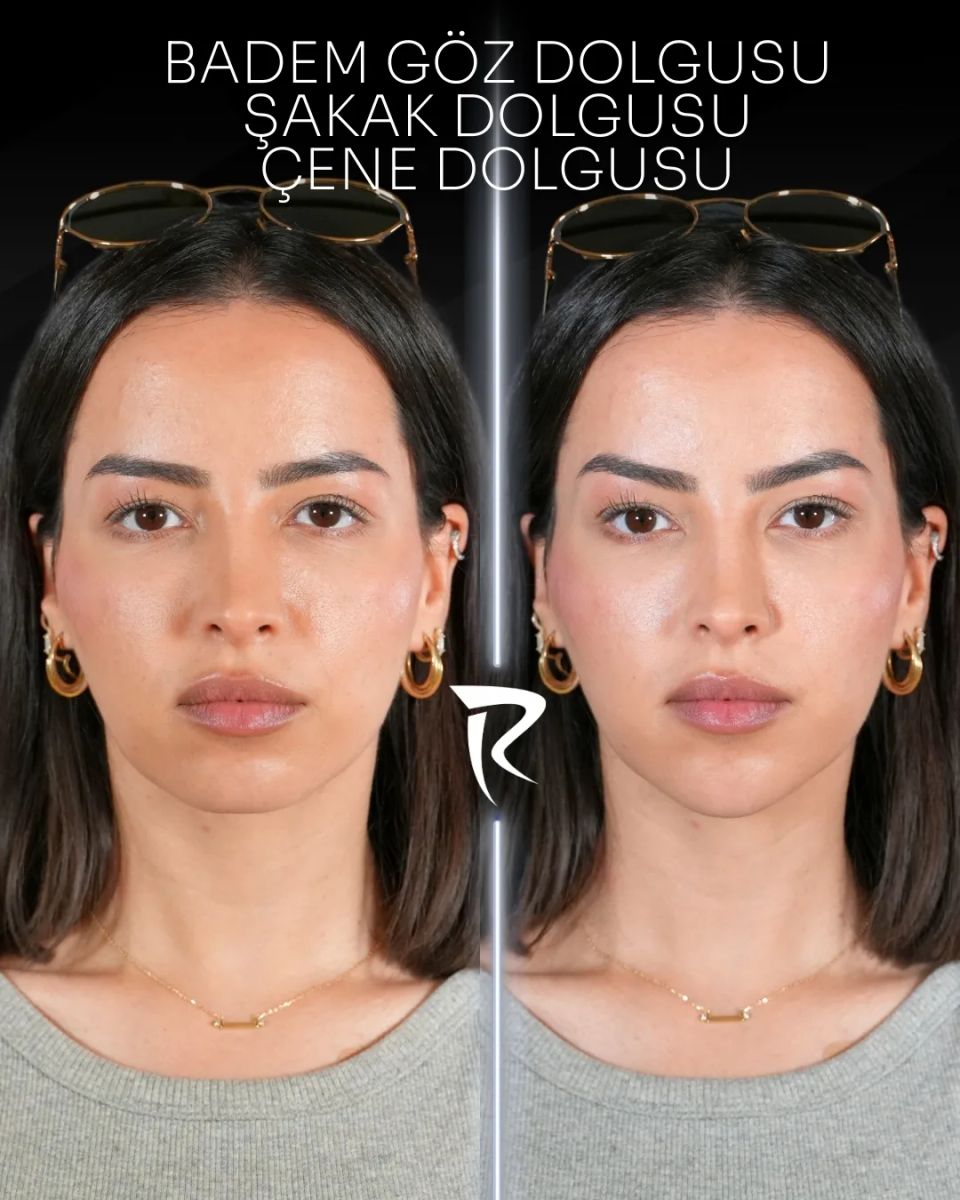 Badem göz, şakak ve çene dolgusu — önden çekim, öncesi ve sonrası