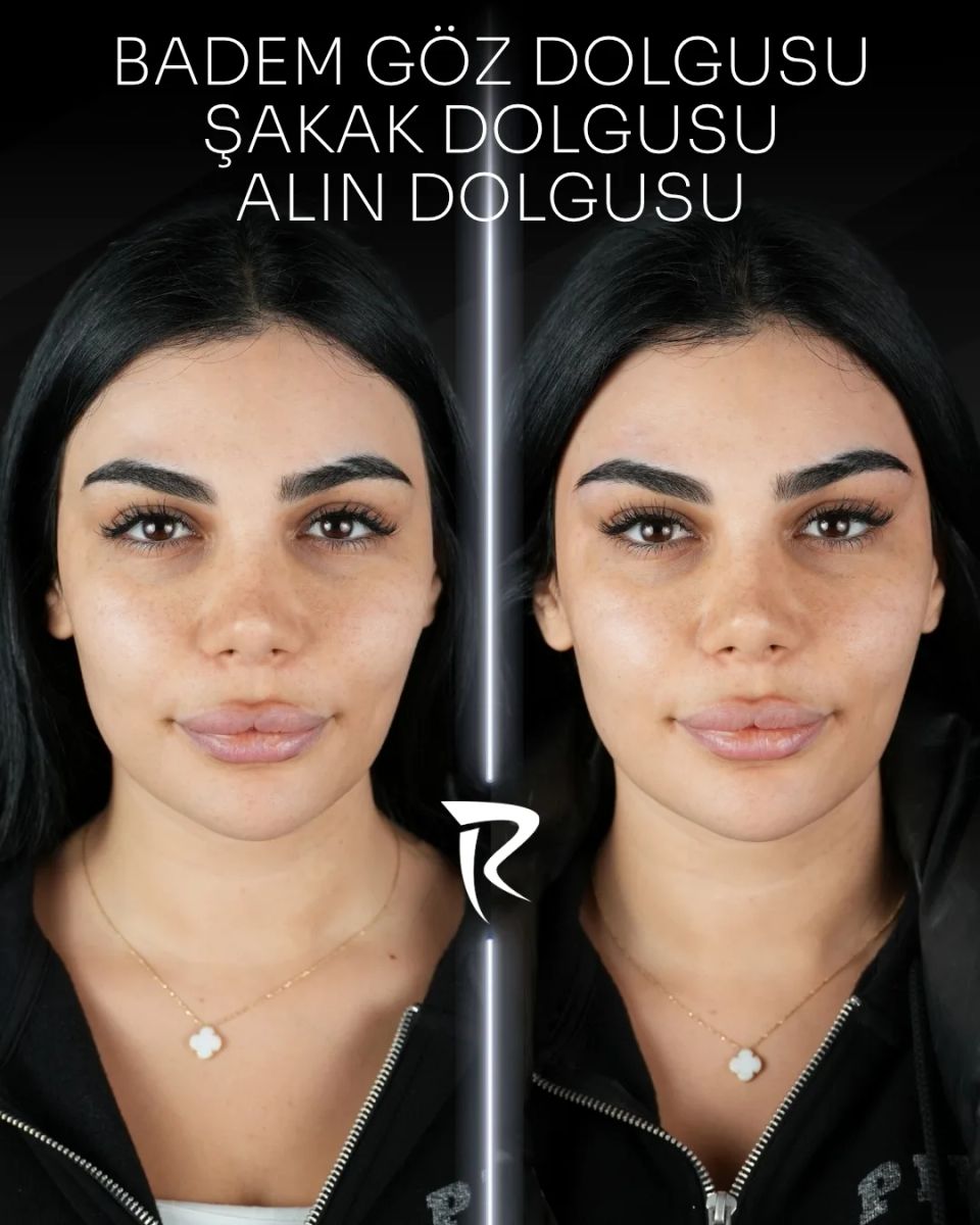 Badem göz, şakak ve alın dolgusu — önden çekim, öncesi ve sonrası