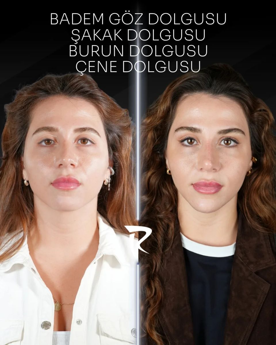Badem göz, şakak, burun ve çene dolgusu — önden çekim, öncesi ve sonrası