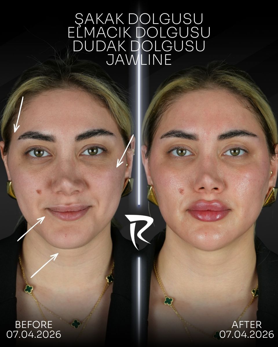 Şakak, elmacık ve dudak dolgusu ile jawline uygulaması — önden çekim, öncesi ve sonrası
