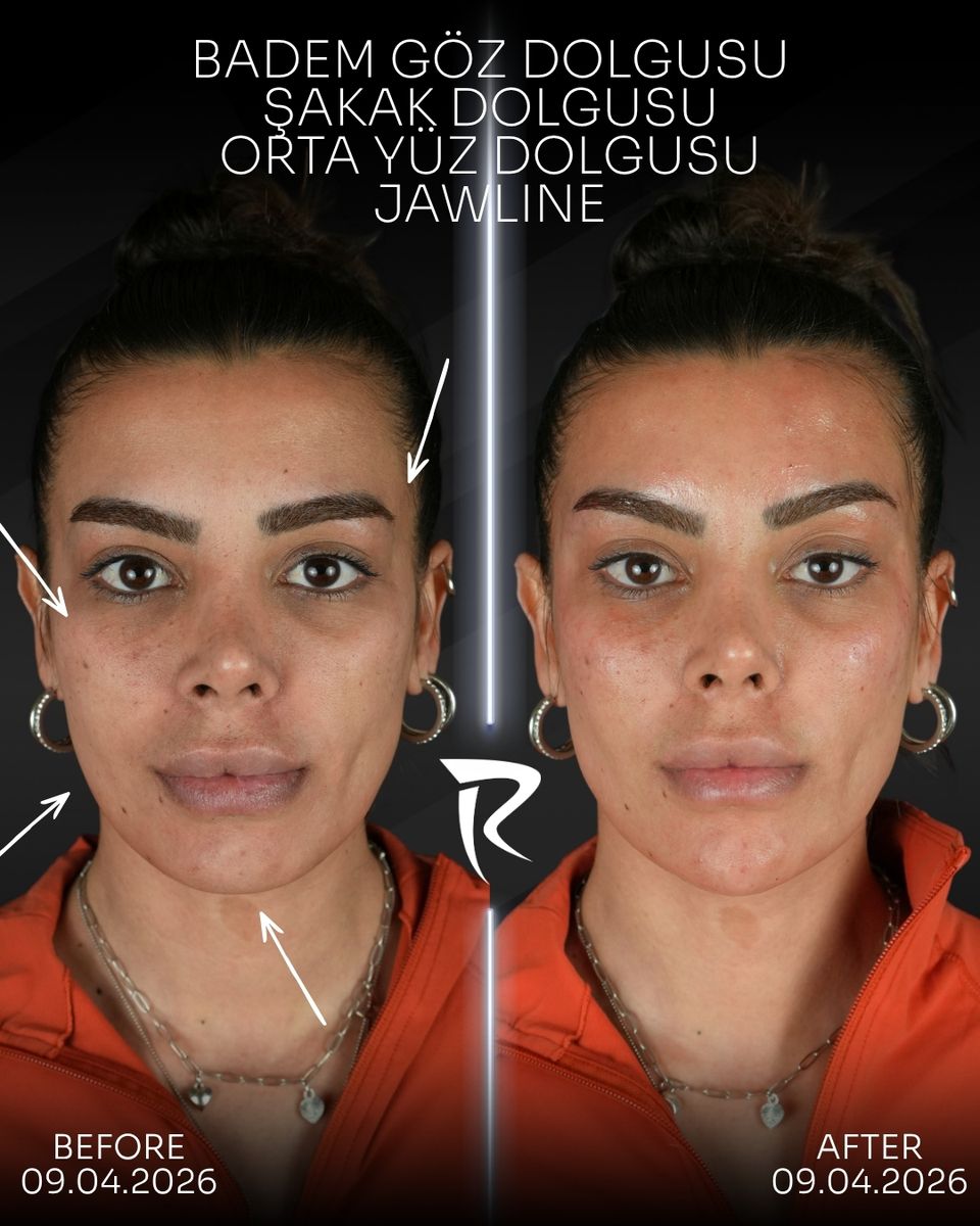 Badem göz, şakak ve orta yüz dolgusu ile jawline uygulaması — önden çekim, öncesi ve sonrası
