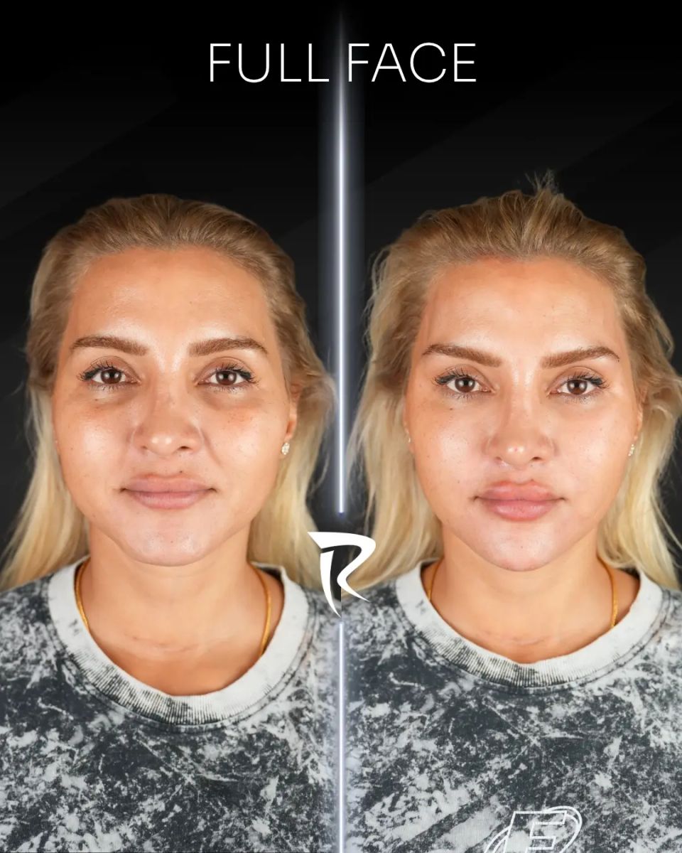Full face dolgu uygulaması — önden çekim, öncesi ve sonrası