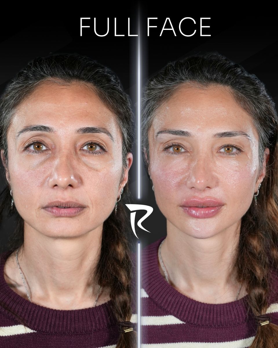 Full face dolgu uygulaması — önden çekim, öncesi ve sonrası