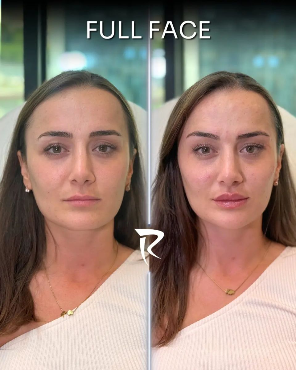 Full face dolgu uygulaması — önden çekim, öncesi ve sonrası