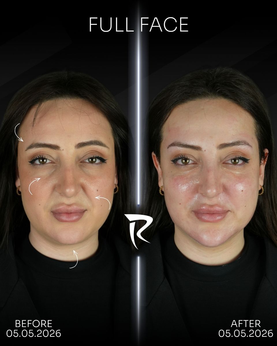 Full face dolgu uygulaması — önden çekim, öncesi ve sonrası