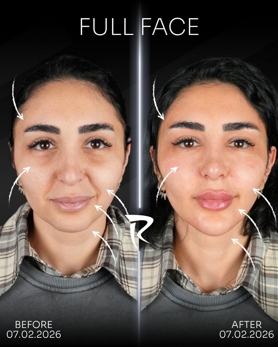 Full face dolgu uygulaması — önden çekim, öncesi ve sonrası